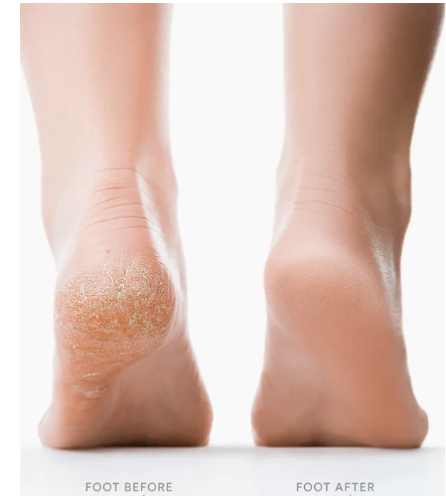 SmoothStep Pro Electric Callus Remover